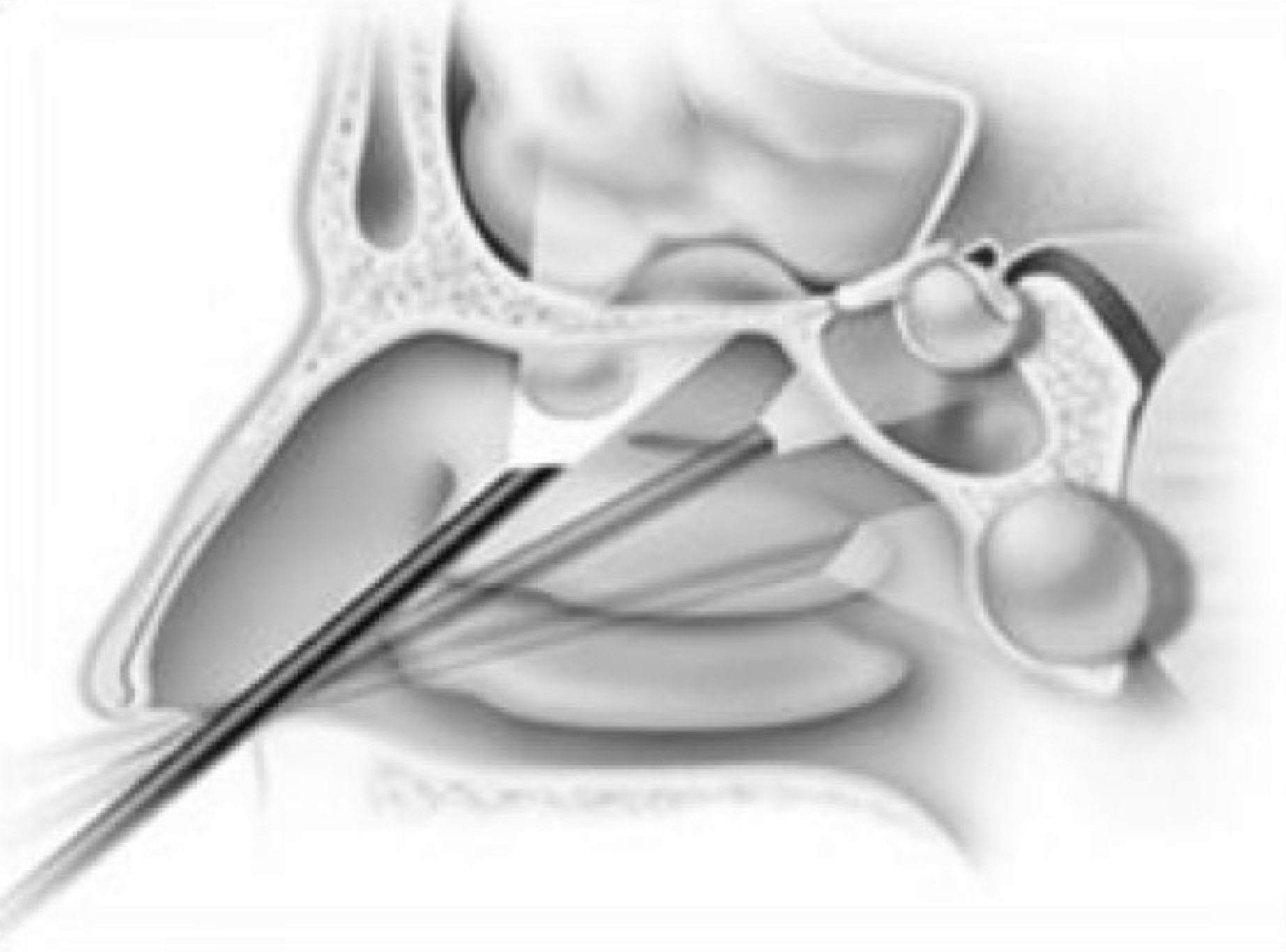 Anterior Cranial Base Tumors